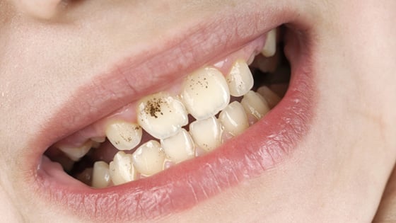 Stained or Discolored Teeth
